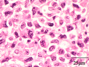 Extranodal NK/T cell lymphoma, nasal type.[89] It may be incidentally discovered in people undergoing surgery for sinusitis.[90]