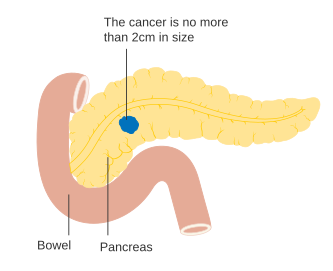 Štádium T1 karcinómu pankreasu