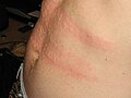 Ospa kod koprivnjače (urtikarije); alergijskog oboljenje kože.