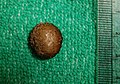 Kamień nerkowy przypadkowo znaleziony w uchyłku pęcherza moczowego przy prostatektomii