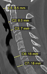 CT scan with upper limits of the thickness of the prevertebral space at different levels.[4]