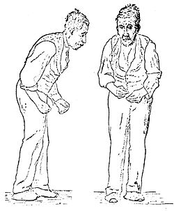 Illustrasie van Parkinson se siekte deur William Richard Gowers, wat in 1886 gepubliseer is in "A Manual of Diseases of the Nervous System".