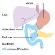 Duodenopankreat­ektomie nach Whipple