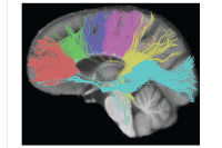同じく拡散テンソル画像のファイバー・トラッキング。これも左の画像と同じ角度から、つまり脳を側面から見ている。脳梁を6つの領域に区分し、それぞれの場所から出て行く神経線維の様子を色分けして表示している。