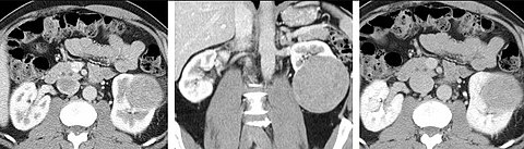 FIGURE 7. Selected images from a renal mass specific protocol CT. Corticomedullary phase (axial 7a) demonstrates peripheral enhancement of the renal cortex with minimal opacification of the renal medulla. There is a large renal cell carcinoma in the left kidney (right in image) which can be differentiated from the normal renal parenchyma by the heterogeneous and differential enhancement. The renal artery and vein are opacified in this phase as well. The collecting system is not opacified (coronal reformat 7b). In the parenchymal phase, the renal cortex and the medulla are enhancing. The renal cell carcinoma in the left kidney is not as well defined when compared to the corticomedullary phase images, but is actually slightly more conspicuous. There is some contrast noted within the collecting system during this phase (7c).[citation needed]