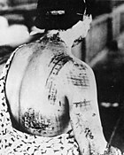 As partes escuras mostram as marcas deixadas pelas roupas que esta vítima usava durante o clarão que causou queimaduras na pele