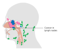 Ethmoid sinus cancer that has spread to the lymph nodes