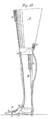 Beinprothese mit mechanischem Kniegelenk nach Caroline Eichler (1834)