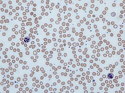 مسحة دم تظهر فقر الدم الناجم عن عوز الحديد، مع خلايا دم حمراء شاحبة، صغيرة.