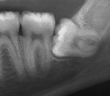 Impacted wisdom tooth with a horizontal orientation