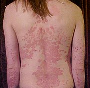 Psoriasis selässä ja käsivarsissa