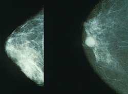 صورة أشعة سينية تبين شكل الورم السرطاني في الثدي (يمين) والثدي الطبيعي (يسار)