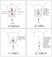 Quatre dessins de vulve montrant les différents types de mutilations