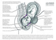 Diagram of maternal and foetal sequelae of prolonged obstructed labour, increasing the risk of obstetric fistula.