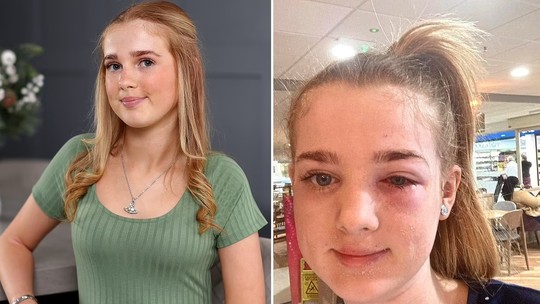 Menina de 13 anos quase fica cega por dica de beleza que viu no TikTok