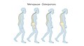 Menopause - Osteoporosis