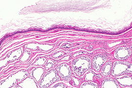 Epidermoid cyst of testis -- low mag.jpg