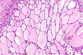 Unclassified renal cell carcinoma - thyroid-like -- intermed mag.jpg