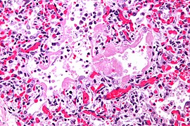 Hyaline membranes - very high mag.jpg